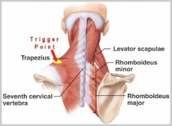 Trigger points